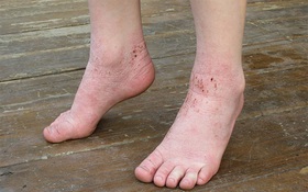 Bệnh về da mùa mưa: Nhiễm khuẩn da và bệnh da do ký sinh trùng