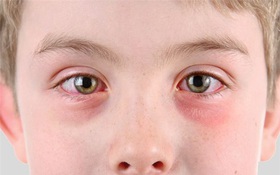 Tổng hợp nguyên nhân gây các dạng đau mắt đỏ và cách nhận biết