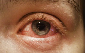 Tổng hợp từ A đến Z về các biến chứng đau mắt đỏ mà người bệnh có nguy cơ mắc phải