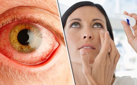 Xuất huyết dưới kết mạc là gì? Đau mắt đỏ chảy máu có nguy hiểm không?