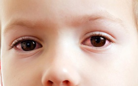 Nguyên nhân gây đau mắt đỏ và nguy cơ làm giảm thị lực nguy hiểm