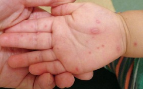 Trẻ bị tay chân miệng nhưng không sốt nguy hiểm như thế nào? Điểm danh những triệu chứng khác