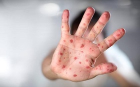 3 sai lầm "kiêng cữ" trong chăm sóc bệnh nhân thủy đậu cần bỏ ngay!