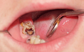 Răng khôn bị sâu: Nguyên nhân và cách điều trị phù hợp