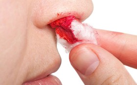 Sốt xuất huyết chảy máu cam có nguy hiểm không? 