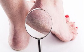 Gót chân bị tróc da là bệnh gì? Làm thế nào để cải thiện?