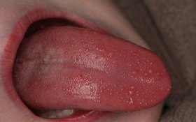 Lưỡi nổi hạt không đau là bệnh gì? 