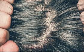 Cách trị ngứa da đầu và rụng tóc an toàn hiệu quả
