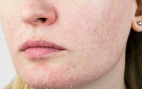 4 thứ cần bổ sung khi chăm sóc da khô mùa hè có thể bạn chưa biết!