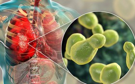 Các loại nấm gây viêm phổi và cách phòng ngừa