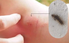 Phát ban do sâu bướm: Cách phát hiện và điều trị