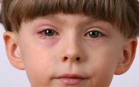 Đau mắt đỏ ở trẻ nhỏ gia tăng: Khi nào cần thăm khám bác sĩ?