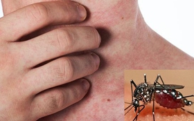 4 vấn đề sức khoẻ bạn có thể gặp sau khi khỏi sốt xuất huyết