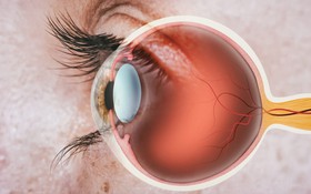 Đau hốc mắt là bị gì? Đau hốc mắt có phải bị viêm xoang không?