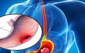 Người bị ung thư dạ dày có chữa được không?
