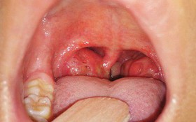Tiếng ve kêu trong tai là bệnh gì?