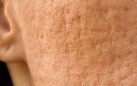 Trị sẹo rỗ cực đơn giản chỉ bằng rau má và vitamin E