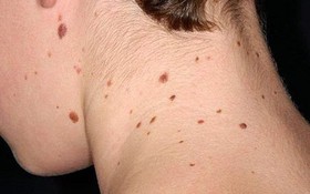 Ung thư da di căn hiểu thế nào cho đúng?