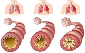 Tìm hiểu về dấu hiệu và cách điều trị hen phế quản độ 2