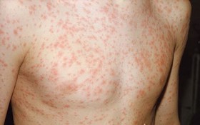 Sốt virus có phát ban không? Những điều cần biết về phát ban do sốt virus