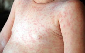 Trẻ bị phát ban sau sốt virus có nguy hiểm không?