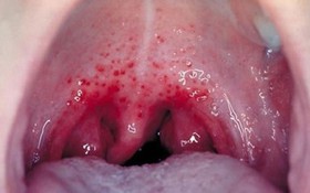 Các thể bệnh lâm sàng của ung thư vòm họng và cách chẩn đoán