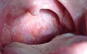 Các vấn đề thường gặp sau điều trị ung thư vòm họng (Tác dụng phụ của các phương pháp điều trị)