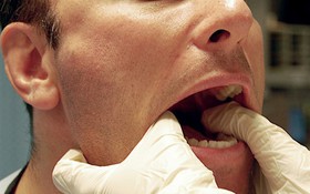Chỉ dẫn cách phân biệt ung thư vòm họng và viêm họng hạt