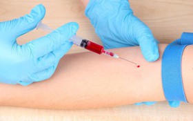 Kết quả xét nghiệm như thế nào là bị sốt xuất huyết?