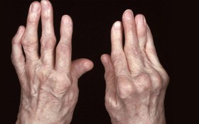 5 đối tượng dễ mắc viêm khớp dạng thấp và lời khuyên trong việc phòng ngừa bệnh