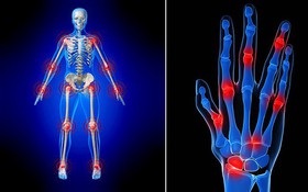 Thuốc giảm đau viêm khớp dạng thấp và một số lưu ý