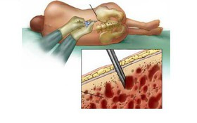 Chọc hút và sinh thiết tủy xương trong chẩn đoán ung thư máu