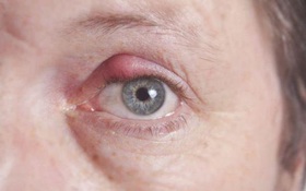 Bệnh lẹo mắt là gì? Dấu hiệu nhận biết và cách phòng tránh