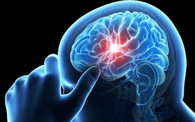 Thiếu máu não là gì? Bệnh có thể dẫn đến tử vong nếu không điều trị sớm