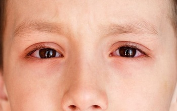 Bệnh đau mắt đỏ: Những điều cần biết về bệnh đau mắt đỏ ở trẻ em