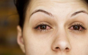 Bệnh đau mắt đỏ có lây không? Cách thức lây lan như thế nào?