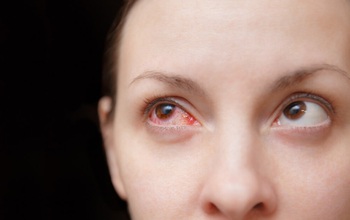 Tìm hiểu chung về bệnh đau mắt đỏ ở phụ nữ mang thai