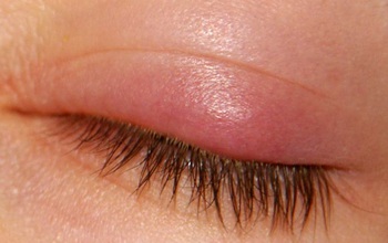 Sưng mi mắt: Đau mắt đỏ có phải nguyên nhân phổ biến nhất?