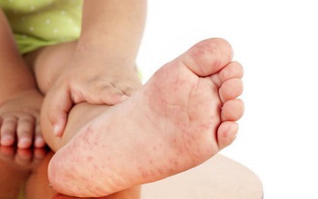 Bệnh tay chân miệng cấp độ 1 ở trẻ nhỏ: Biểu hiện, điều trị và phòng tránh