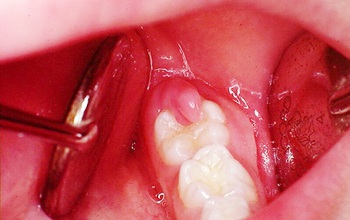 Tất tần tật thông tin từ A tới Z về sưng nướu răng