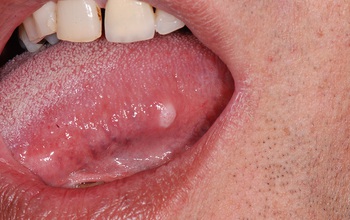 Ung thư lưỡi là gì? Tổng quan về căn bệnh ung thư lưỡi