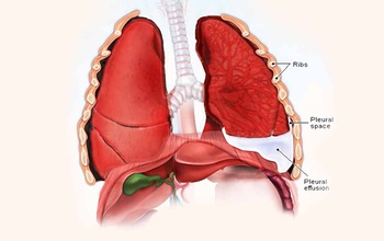 Tràn dịch màng phổi là gì? Nguyên nhân, triệu chứng và cách điều trị tràn dịch màng phổi