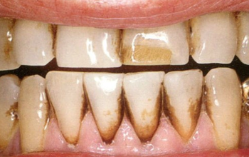 Kẽ răng bị đen do đâu và cách điều trị an toàn