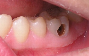 5 dấu hiệu răng bị chết tủy cần xử lý nha khoa sớm