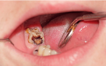 Răng khôn bị sâu: Nguyên nhân và cách điều trị phù hợp