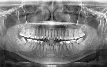 Tìm hiểu về chụp X quang răng và những điều cần lưu ý