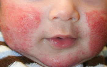 Những vấn đề về da ở trẻ thường gặp vào mùa đông