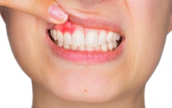 Cần làm gì khi bị sưng nướu răng và nổi hạch?