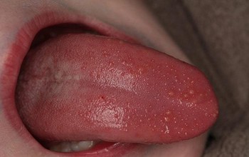 Lưỡi nổi hạt không đau là bệnh gì? 