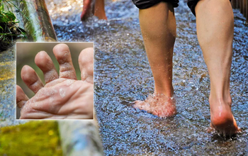 Nước ăn chân mùa mưa và cách xử lý tại nhà hiệu quả nhất